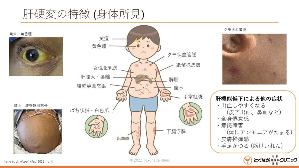 肝硬変 のイメージ画像